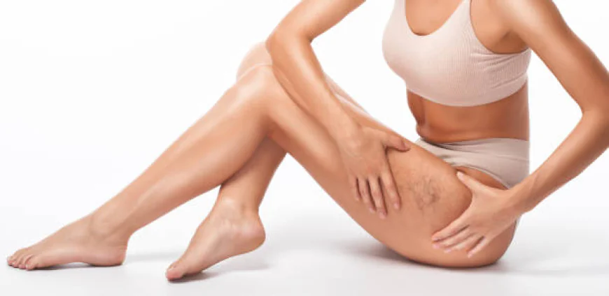 Can Spider Veins Treatment Restore Smooth Skin?