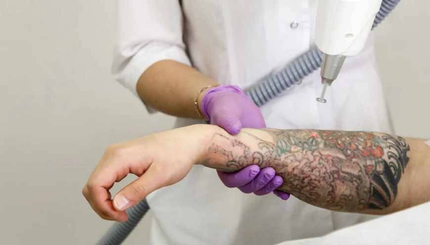 Is Laser Tattoo Removal Considered a Safe Treatment?
