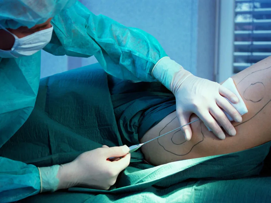 How Compression Garments Help After Liposuction Surgery