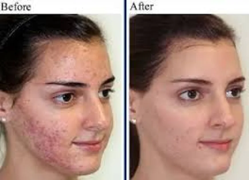 Scar Removal in Dubai | Restore Smooth, Healthy-Looking Skin
