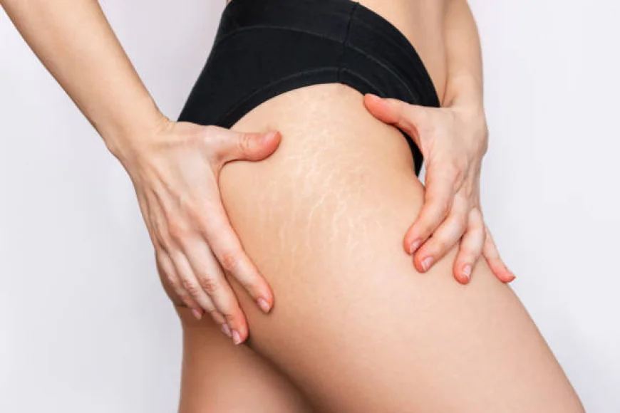 How Does Enfield Royal Clinic Treat Stretch Marks?