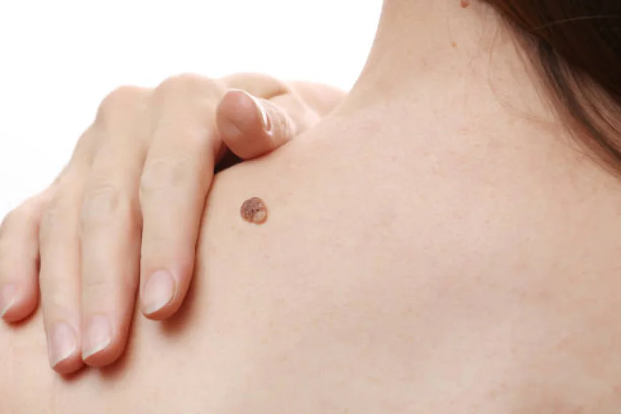 How safe is Mole Removal treatment today
