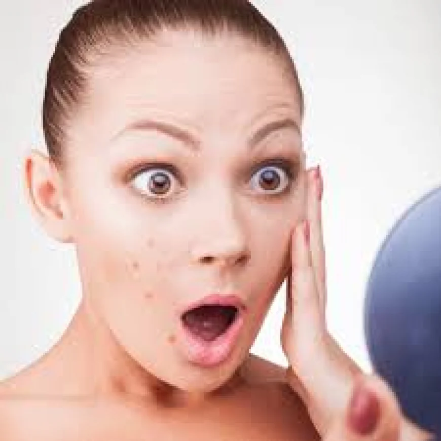 Acne Removal in Dubai: Understanding Modern Solutions for Clearer Skin