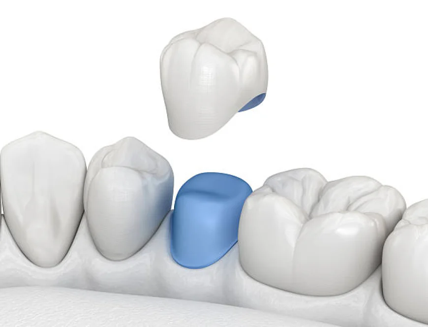 Can Dental Crowns Restore Both Strength and Appearance Naturally?