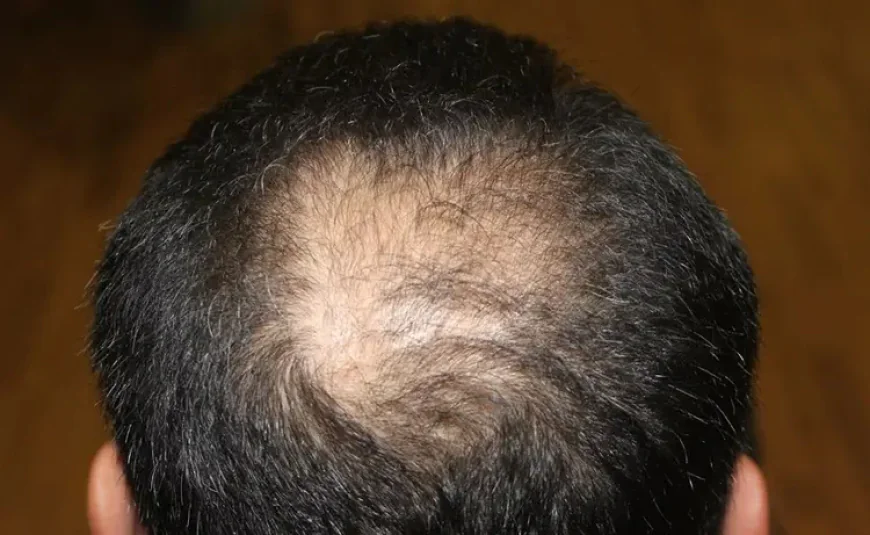 Is Crown Hair Transplant Right for Thinning Crown Hair Now?