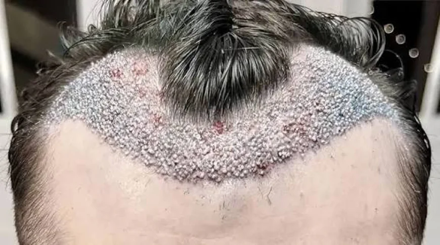 How Fue Hair Transplant Supports Hair Restoration