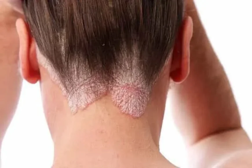 Can Poor Hygiene Increase the Risk of Skin Diseases?