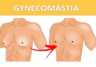 Understanding What Influences Gynecomastia Surgery Pricing