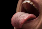 Tongue Ties, Feeding, and the Role of Orofacial Myofunctional Therapy