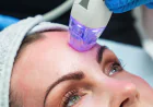 How Fractional RF Microneedling Supports Skin Renewal