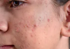 Which Acne Treatment suits oily skin best