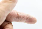 Psoriasis Treatment Market: Size, Trends, Growth, and Strategic Insights