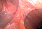 Abdominal Adhesions: Symptoms, Causes, and Treatment Options