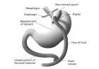 Foods to Avoid After Gastric Bypass Surgery for Better Health