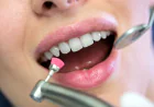Teeth Cleaning in Dubai: Benefits You Should Know