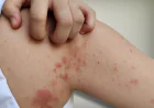 Can Poor Hygiene Cause Skin Diseases?