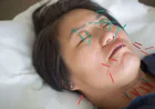 Facial Rejuvenation Acupuncture Before an Event: Timeline