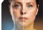 How Can Fotona SmoothEye Improve the Appearance of the Delicate Eye Area?