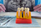 Implant Dentist: What to Expect During Your Implant Procedure Skills