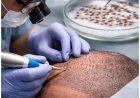 Hair Transplant in Islamabad: How to Choose the Right Treatment for Hair Loss