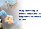 Why Investing in Dental Implants Can Improve Your Quality of Life
