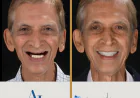 Full Mouth Rehabilitation: More Than Just Teeth Replacement