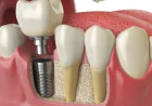 What Makes the Best Dental Implants Lahore a Good Choice?