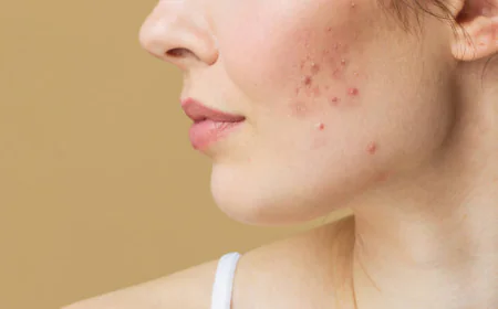 Which Acne Treatment works for oily skin
