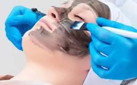 Carbon Peel for Acne, Open Pores and Dull Skin — What This Treatment Actually Does
