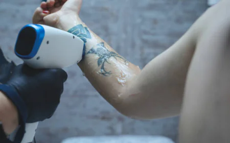 Does Laser Tattoo Removal leave scars