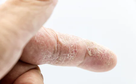 Psoriasis Treatment Market: Size, Trends, Growth, and Strategic Insights