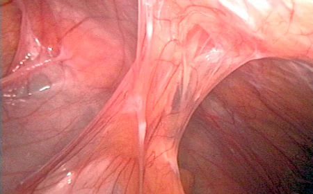 Abdominal Adhesions: Symptoms, Causes, and Treatment Options