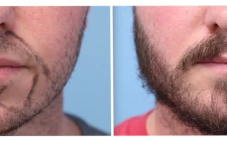 How does Facial Hair Restoration Work?