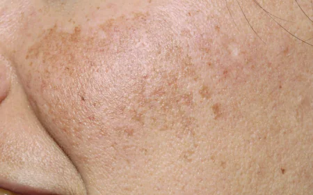Is Pigmentation Treatment Safe for Sensitive Facial Skin