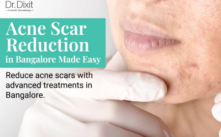 MNRF Treatment: How Effectively It Helps in Acne Scar Management