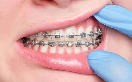 Dental Braces in Dubai for a Straighter Smile