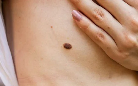 Can Skin Tag Removal Be Done Without Surgery Safely?