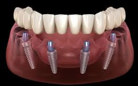 All-on-4 Dental Treatment: Understanding Your Options for Tooth Replacement