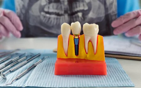 Implant Dentist: What to Expect During Your Implant Procedure Skills