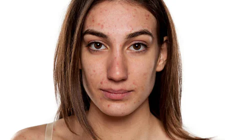Can Acne Treatment Help Clear Congested Acne-Prone Skin?
