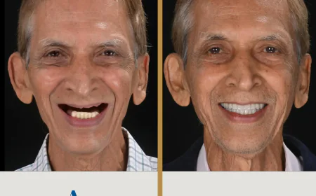 Full Mouth Rehabilitation: More Than Just Teeth Replacement