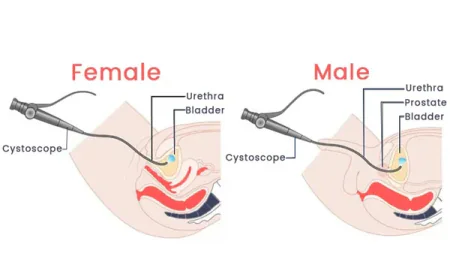 OIU / VIU Surgery in Gurgaon: Minimally Invasive Treatment for Urethral Stricture
