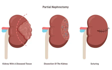 Partial Nephrectomy in Gurgaon: Preserving Kidney Function with Modern Surgical Care