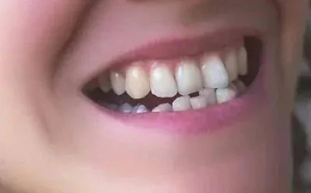Crooked Teeth Treatment Using Modern Dental Techniques | Glamorous Clinic Dubai