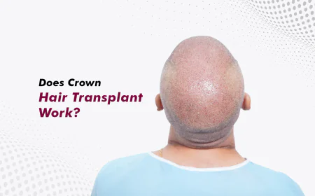 Best Hair Transplant in Gurgaon: How to Choose the Right Clinic and Treatment
