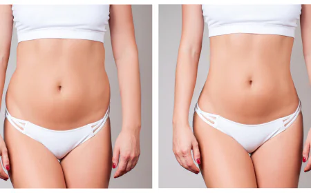 Liposuction in Islamabad: Why Choosing the Right Clinic Matters
