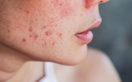 How Soon Can Acne Treatment Show Visible Skin Results?
