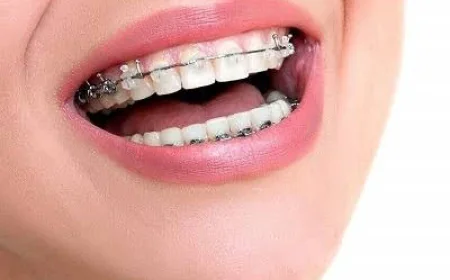 Teeth Braces in Dubai & Abu Dhabi: Start Your Smile Journey | Glamorous Clinic Dubai