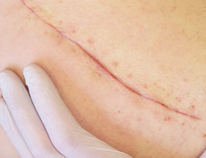 Is Facial Scar Revision Suitable for All Skin Types?