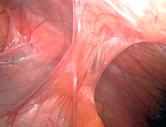 Abdominal Adhesions: Symptoms, Causes, and Treatment Options